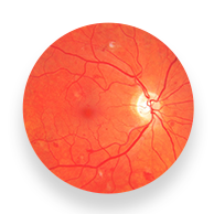 RETINA